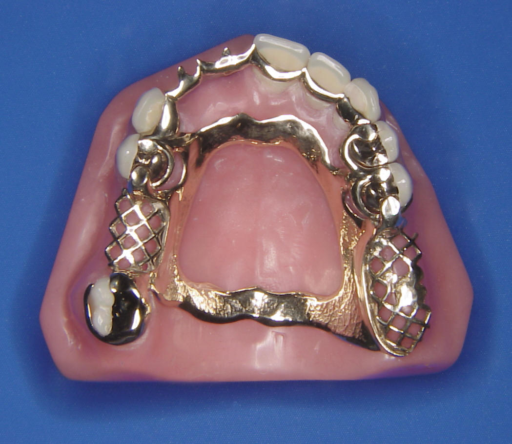 cast parial dentures
