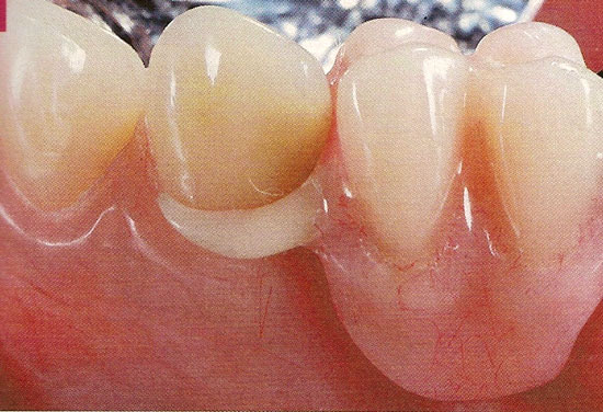 fibre denture