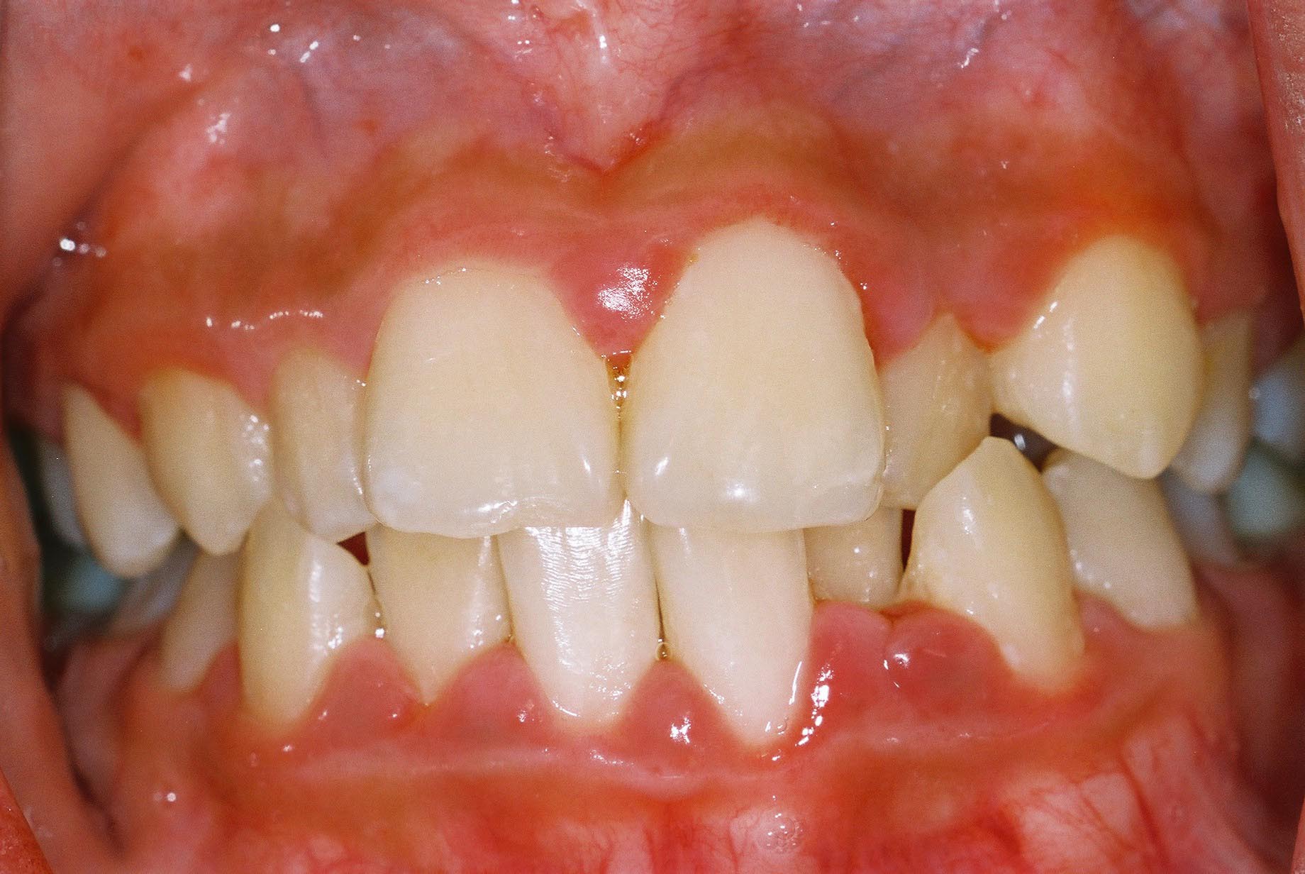 irregular teeth