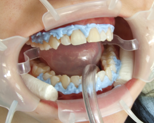 teeth whitenning process