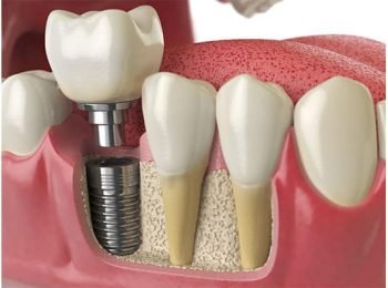 Prosthodontics-img